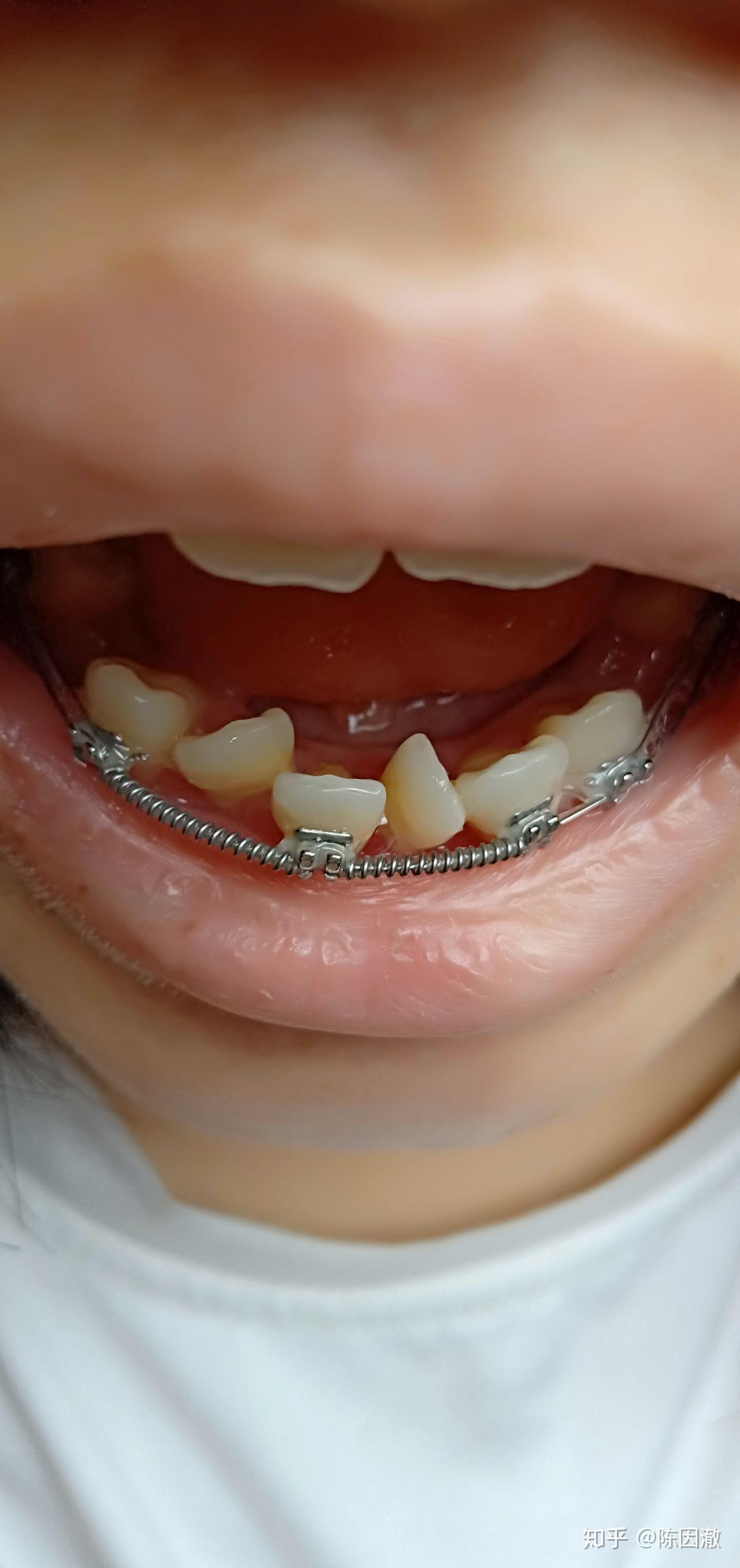 牙不齐(倾斜,拥挤)是怎样的体验?