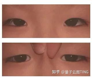内斜视的分类 - 知乎