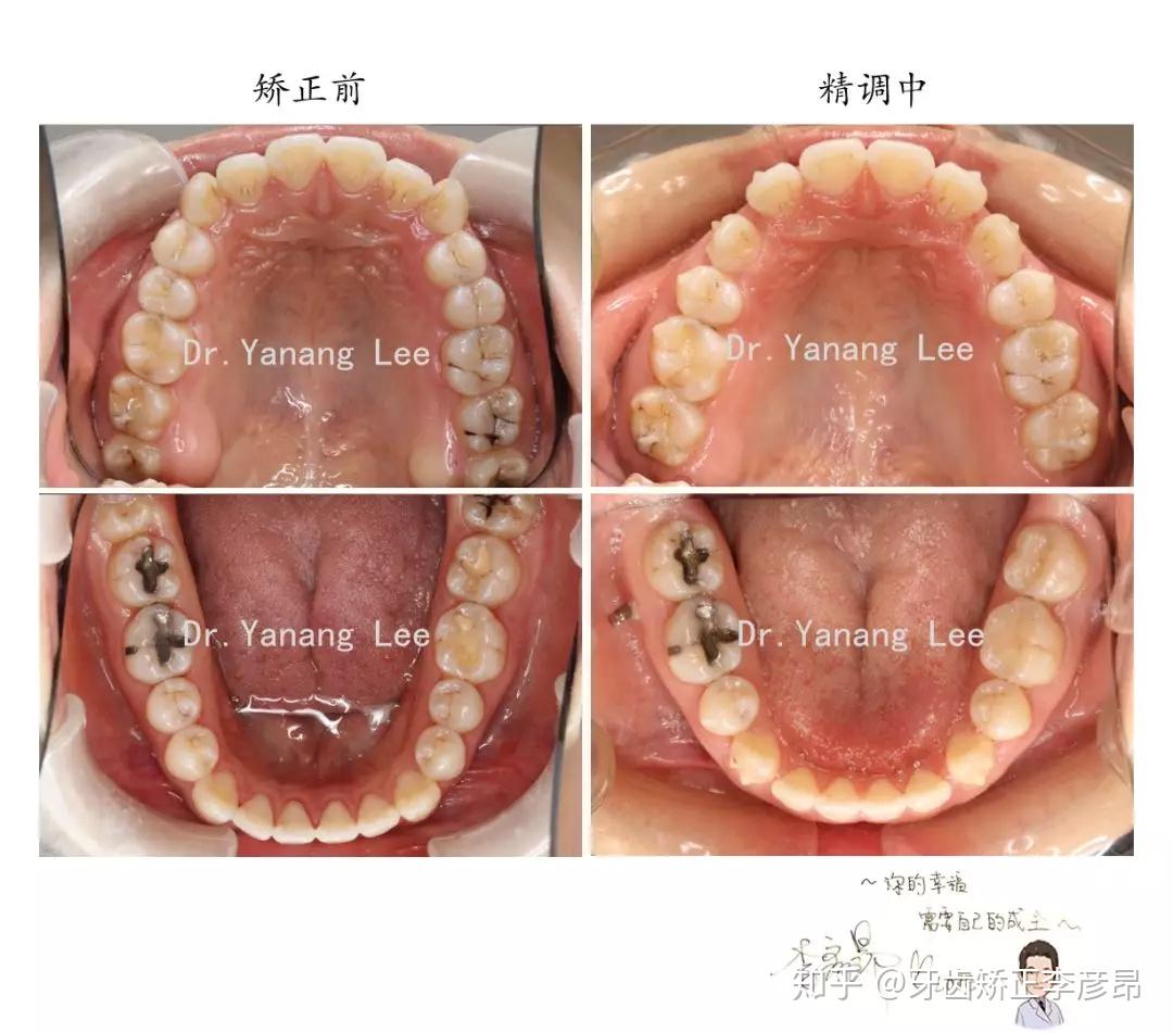 继续加油~方案设计拔四颗正畸牙 四颗智齿,内收前牙,矫正至今已经一年