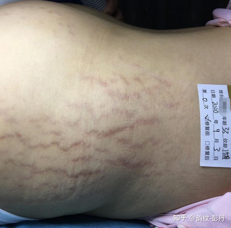 第一胎长了妊娠纹,现在第二胎刚刚怀上,哪种淡化妊娠纹的品牌效果好一