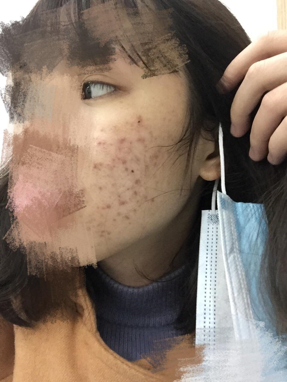 一个痘痘患者的心酸抗痘史密集恐惧者慎点多图慎点