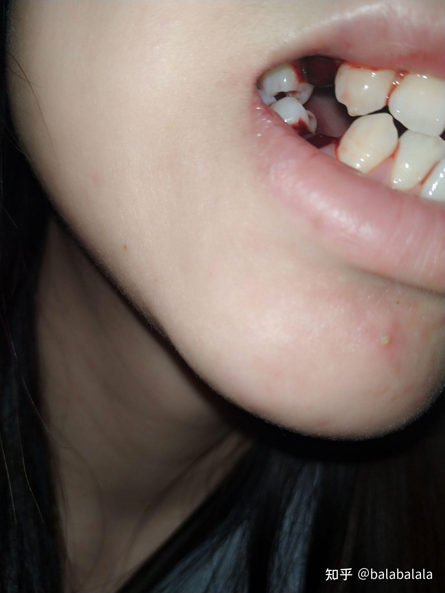 果然不出我所料,是邻面龋,很难被发现,拍了ct才能看到,很浅,但是比较