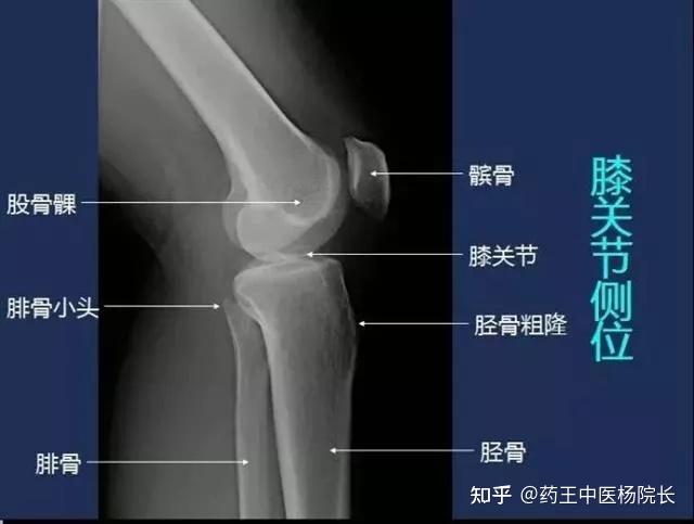 同时还有一块小骨头随着膝关节运动在股骨表面滑动,叫做髌骨