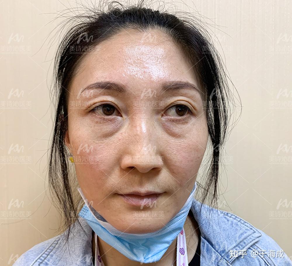 带你深扒眼袋形成的原因对症下药更有效