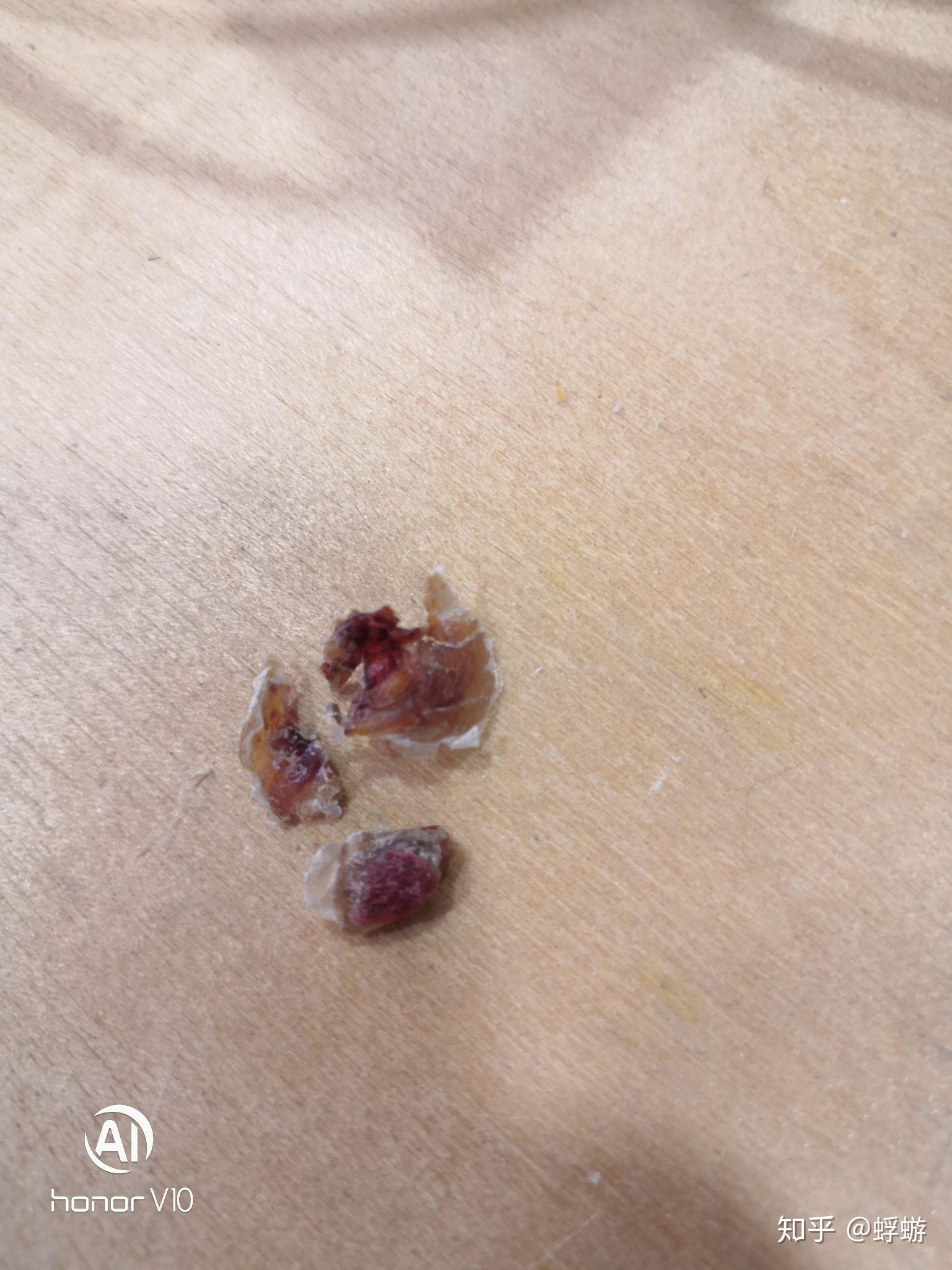 寻常疣—再也不会选择冷冻的治疗经历!