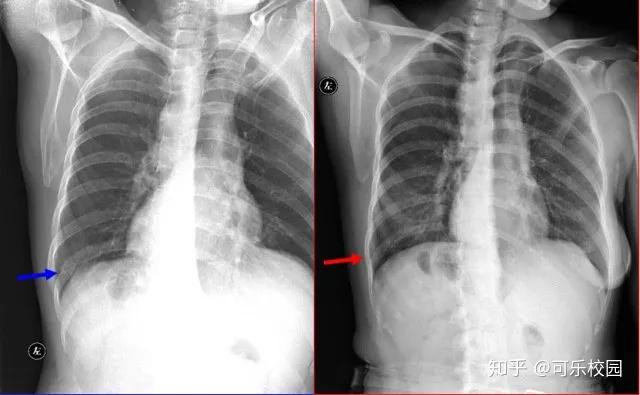110张经典x线片影像诊断夜班医生必备纯干货