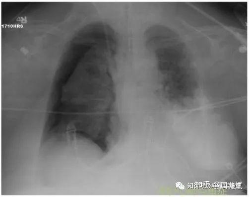 第122期 气胸患者机械通气的模式与参数,如何选择与设置? - 知乎