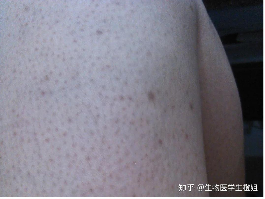 为什么后背老爱长痘痘？ - 知乎