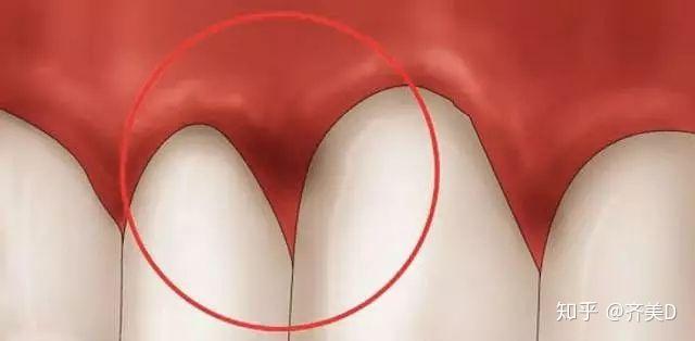 萎缩;与此同时,细菌不断向内入侵,引起牙槽骨吸收,整个牙床的高度和