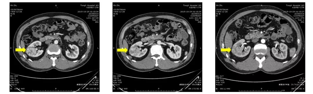 完全內生性腎癌的機器人保留腎單位手術