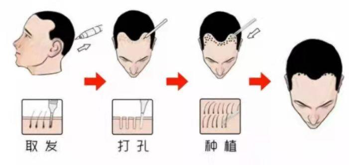 科普植发原理、影响植发效果因素、如何选择植发医院！ - 知乎