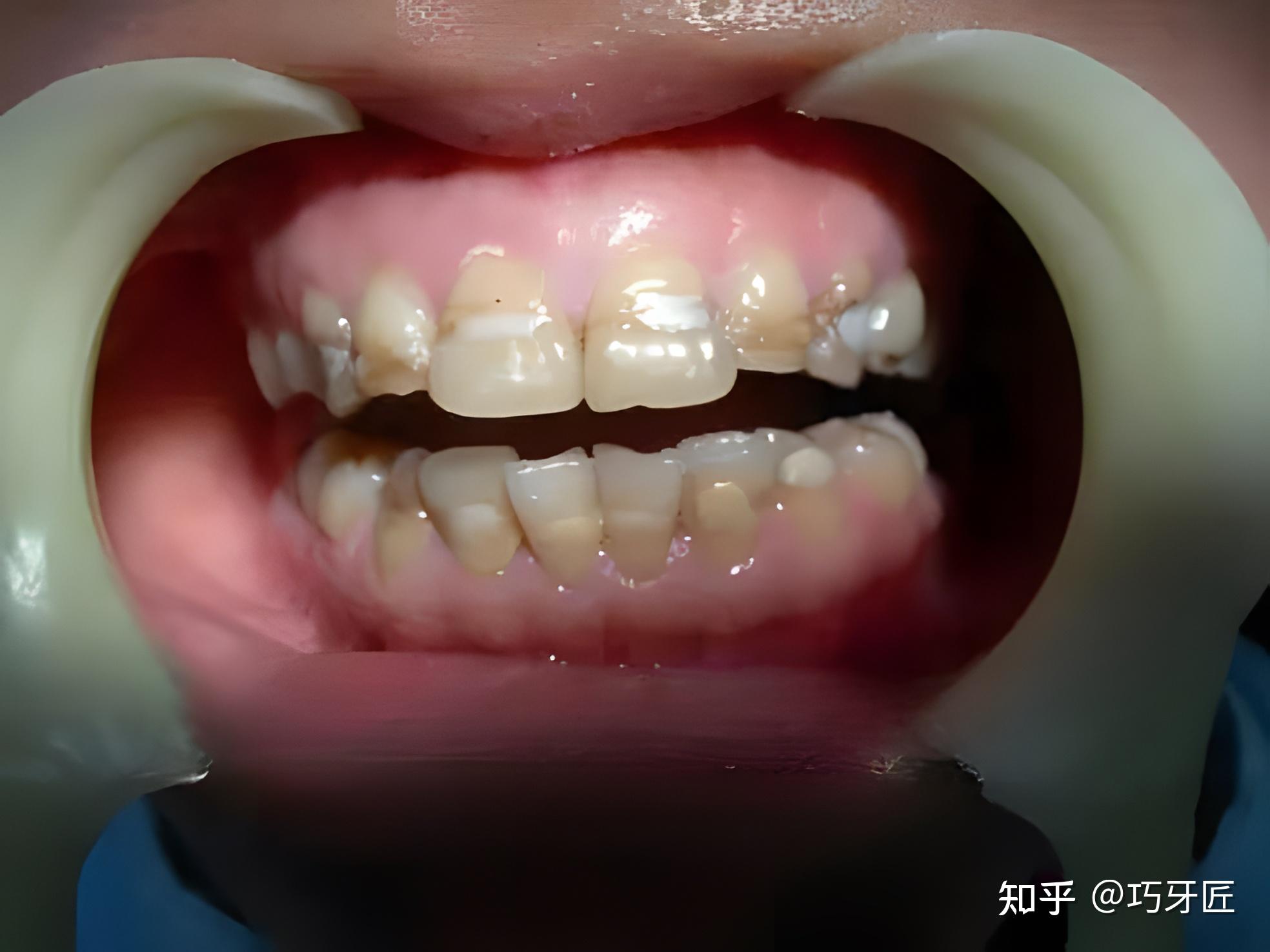 牙齿上长了一块一块的白斑？牙釉质脱矿、早期龋根本没听说过？让大白来告诉你，不是牙黑了才是“虫牙”～ - 知乎