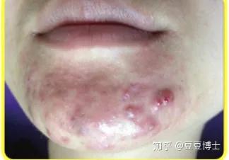 痘痘反复生长,那是痘根在作怪! - 知乎