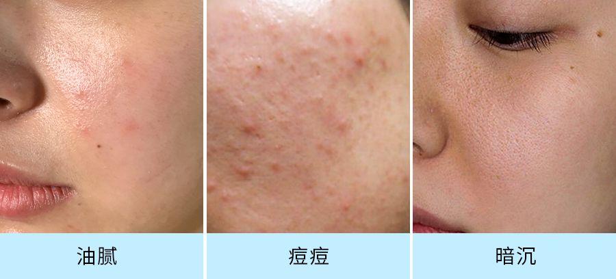 一,油痘肌护肤思路