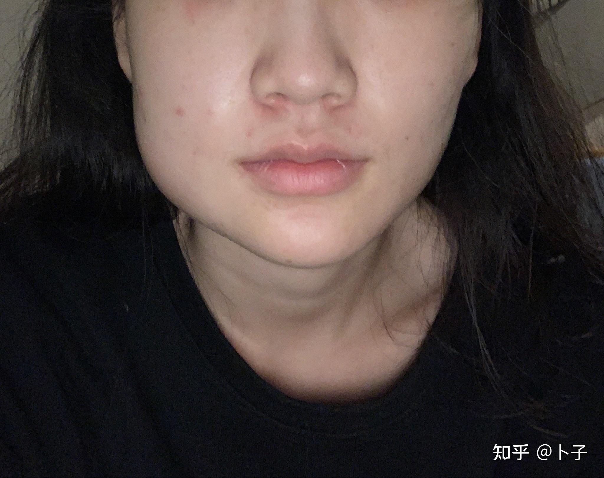 武大口腔医院正畸拔智齿