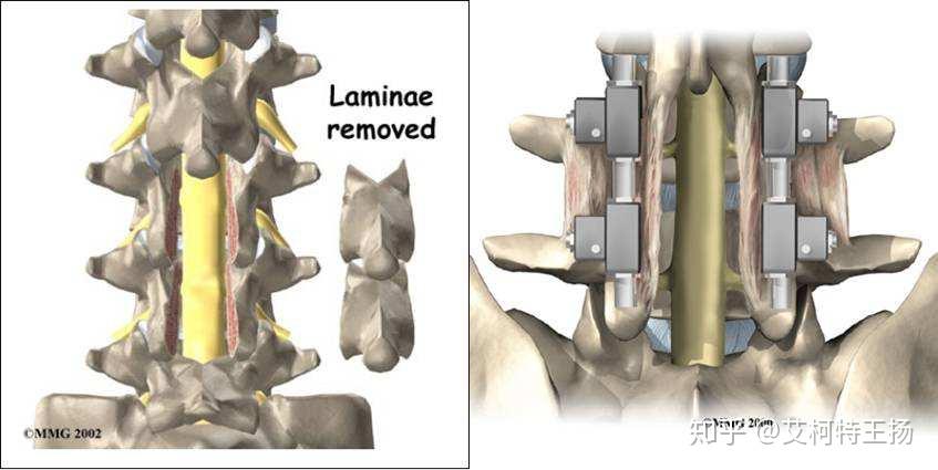 第四步:稳定伤口内部,完成手术.