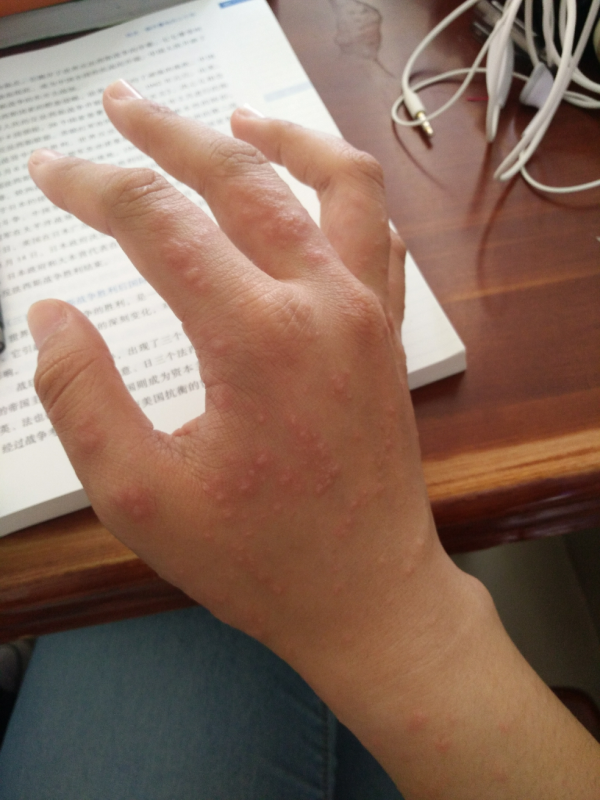 漫步全身,各种痒痒各种流水, 晚上整宿整宿睡不着,除了长湿疹的地方痒