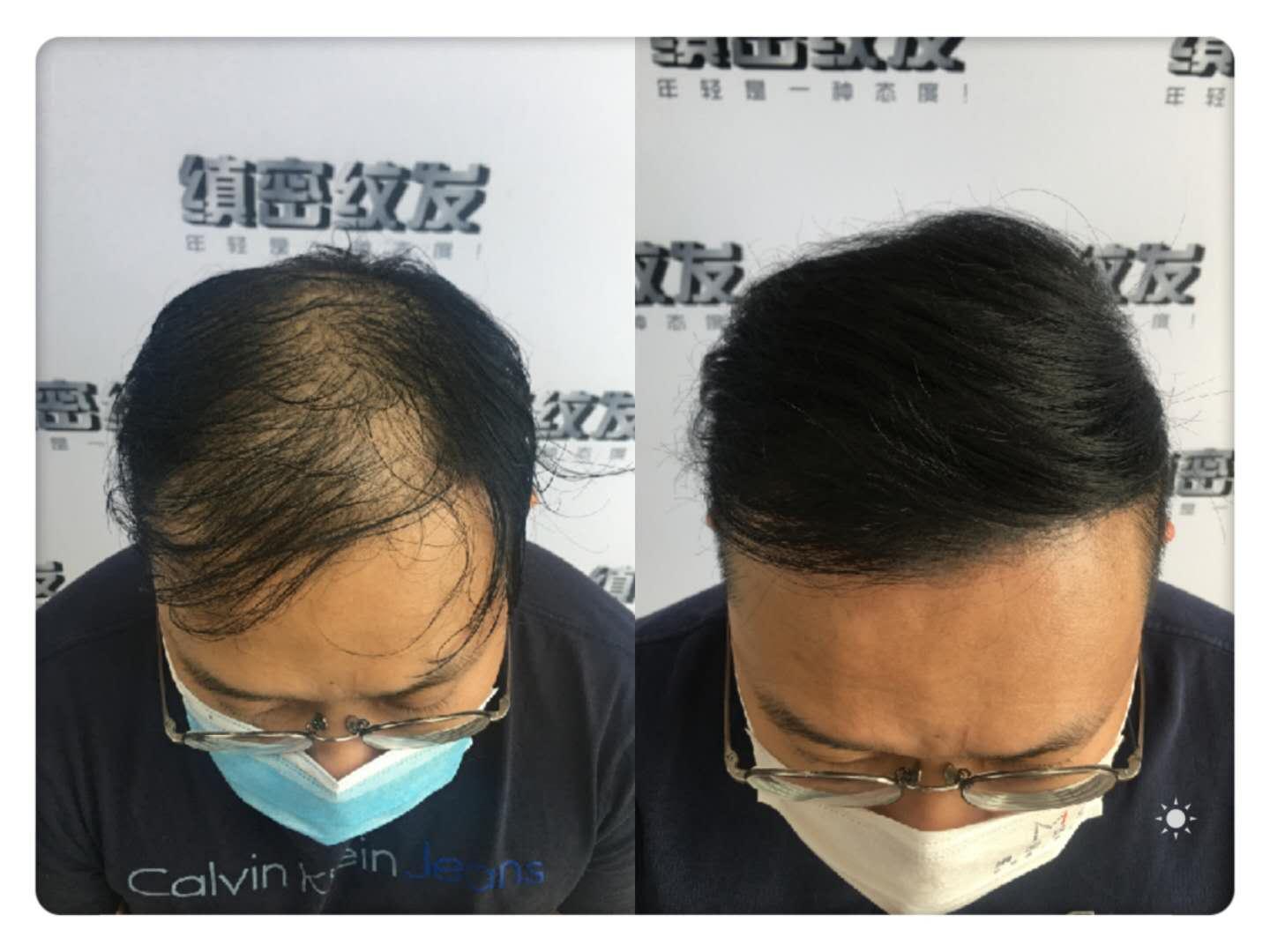 男性秃顶意味着什么？不全是坏事 至少还有这点好处！ - 知乎