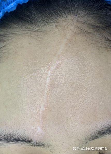 额部色脱疤痕修复案例