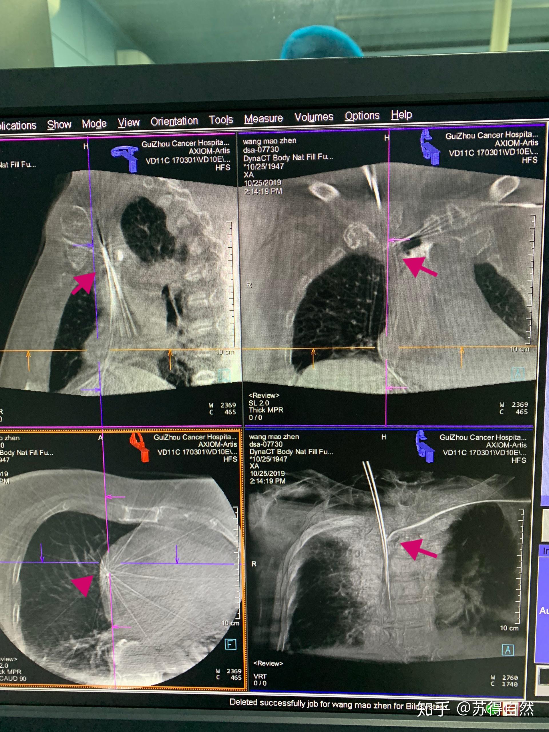 直穿上腔静脉开通左侧头臂静脉 - 知乎