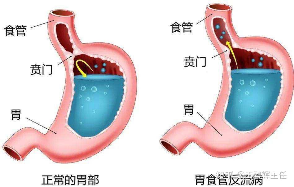 引起胸痛、增加心梗风险？胃食管反流病，你需要多留意！ - 知乎