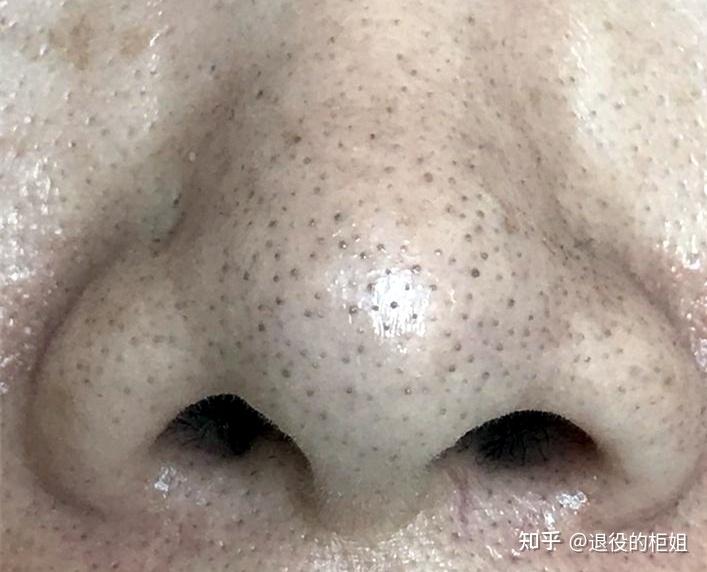 黑头就这样形成了.