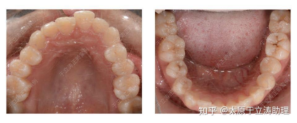 一般檢查:面部左右不對稱;右側上頜1-4反頜;上頜擁擠;左右上頜牙弓不