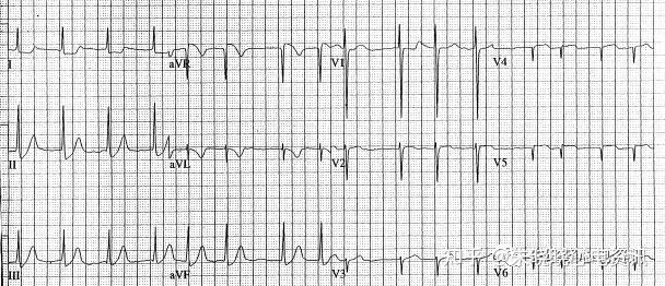 臨床實踐中,典型心絞痛患者出現心電圖相應導聯(如ii,iii,avf導聯)st