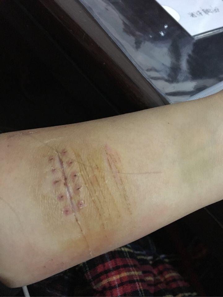 我胳膊有2条疤大概2厘米长凸出来的用喜疗疤可以去掉吗或者激光植皮