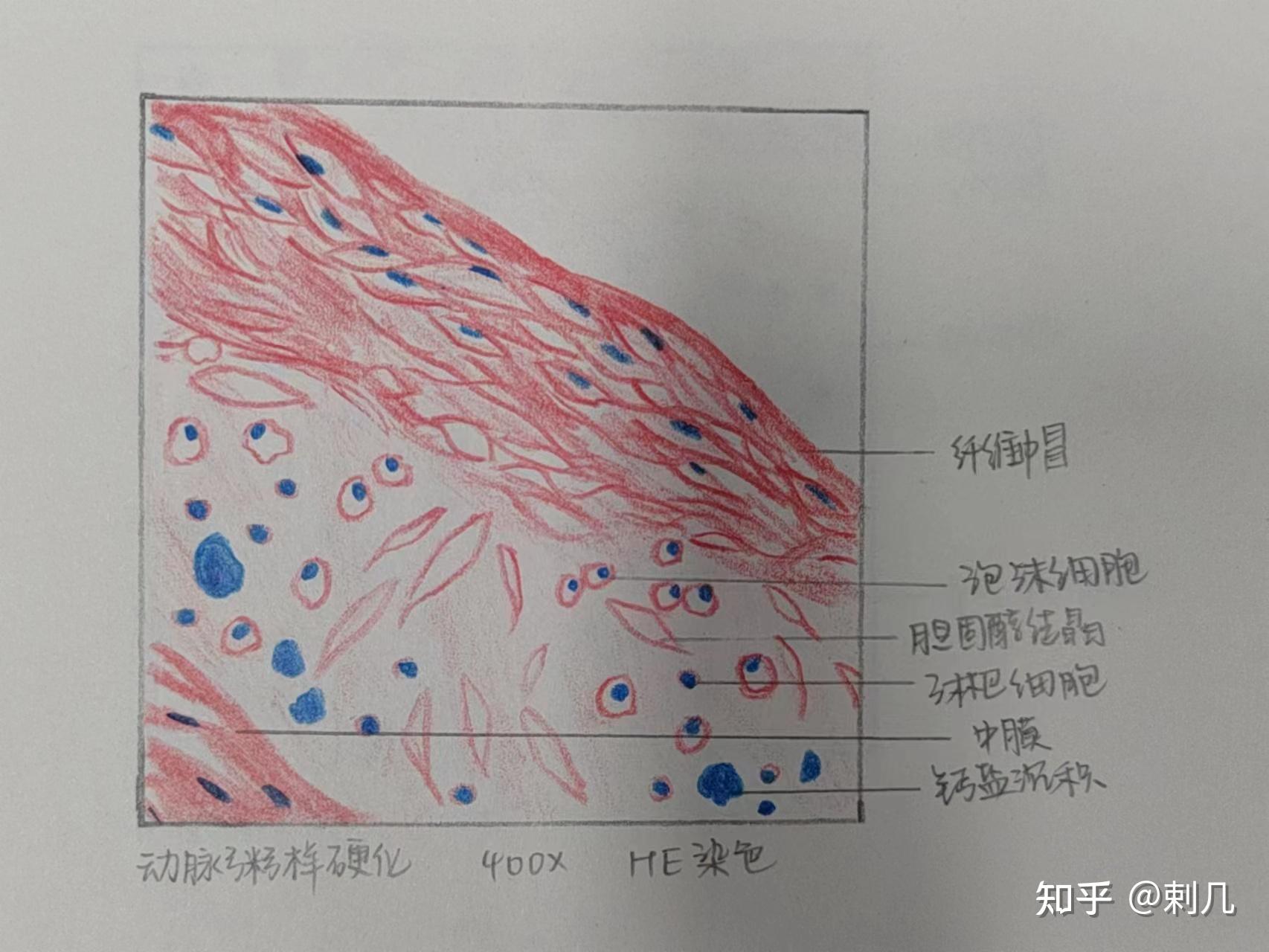 绒毛膜癌病理手绘图图片