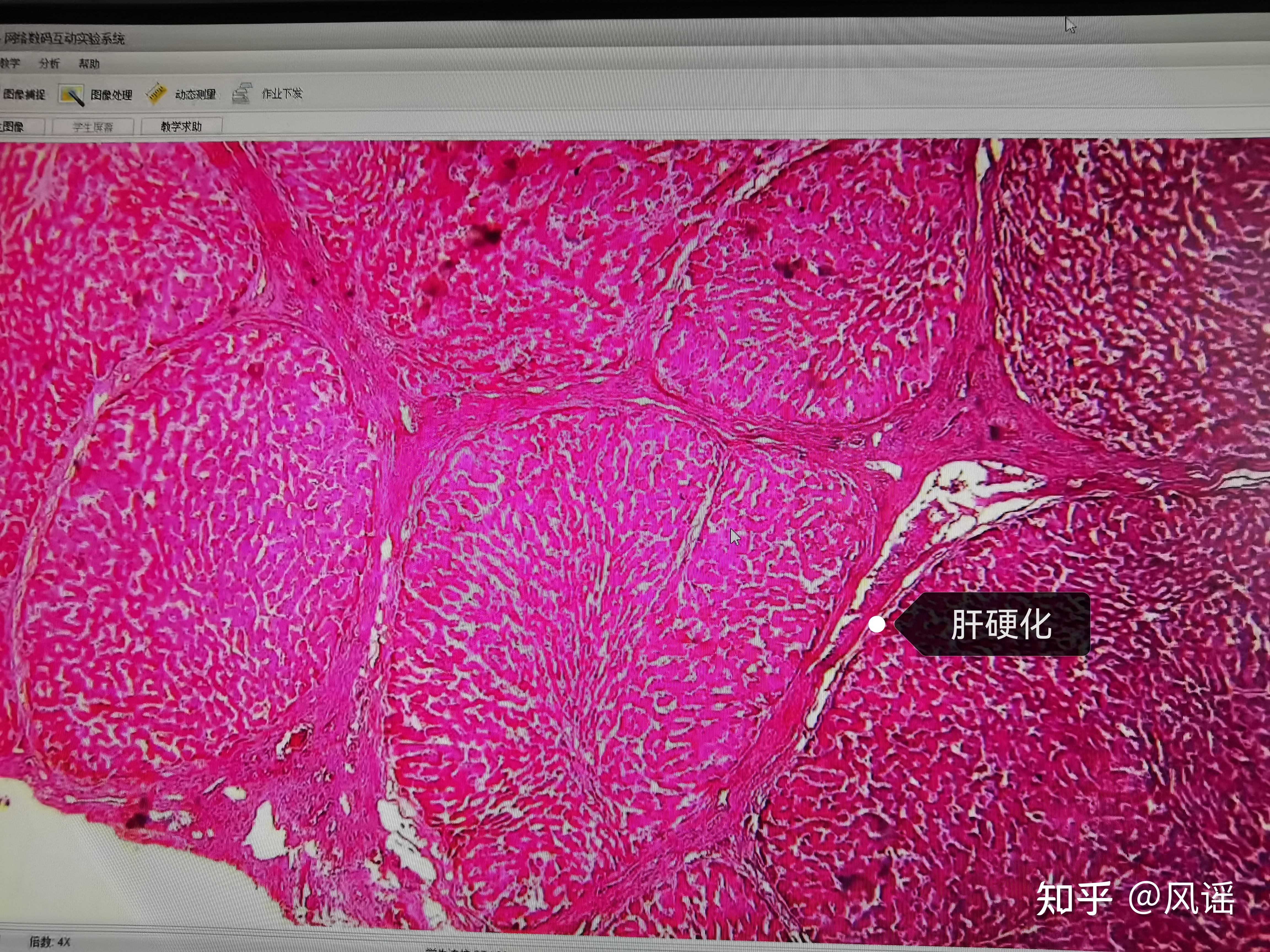 肝细胞假小叶图片