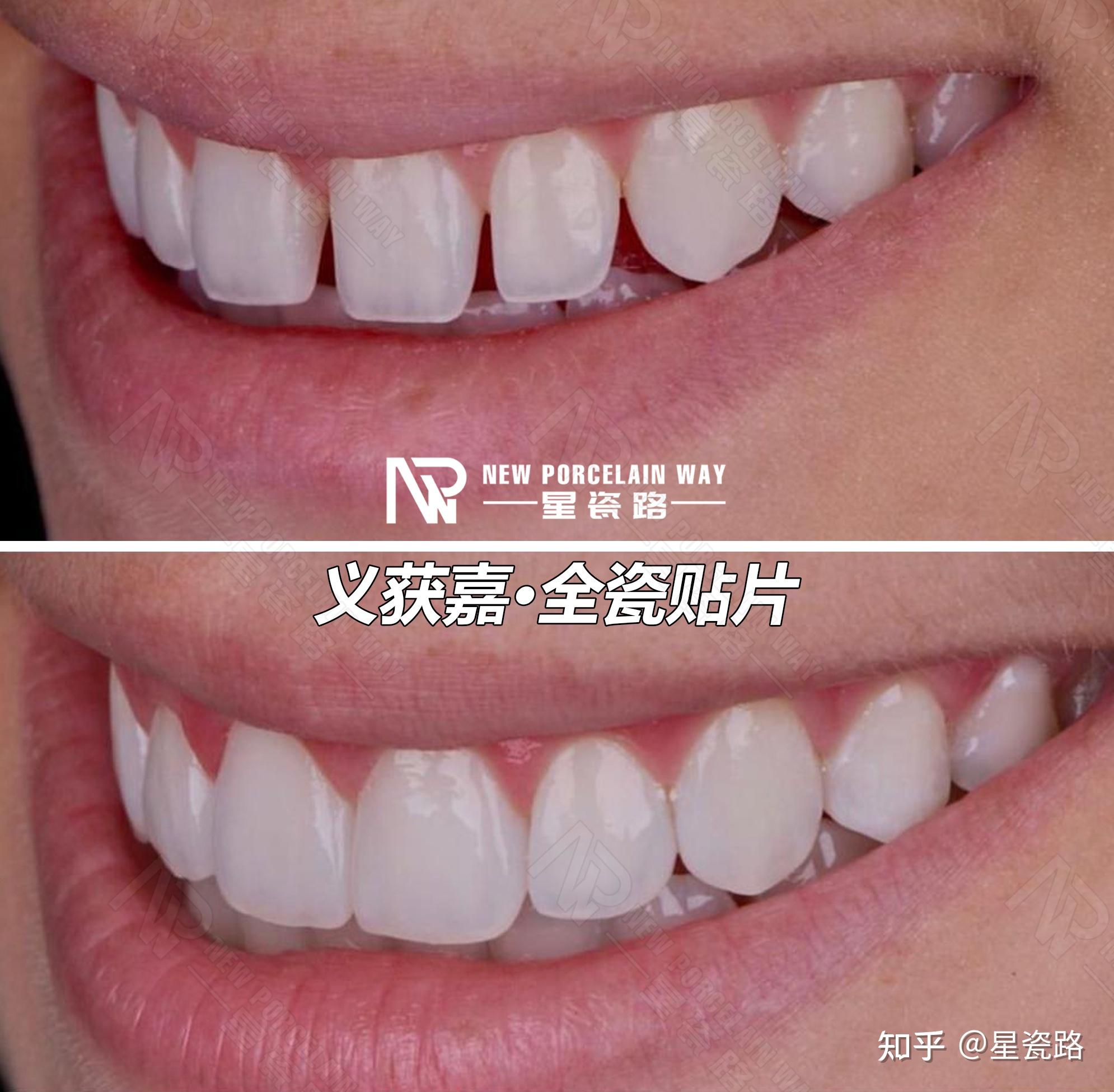 美容牙齿贴面 完美无瑕的美尽在 曼谷微笑牙科诊所