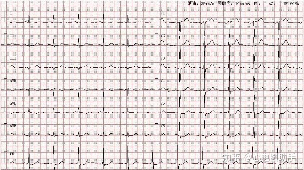 14种异常心电图图片