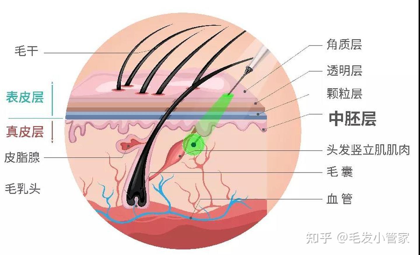 脂溢性脱发的根本原因(脂溢性脱发的根本原因是雄性激素过高)