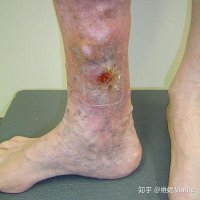 微莫斯科普:下肢静脉曲张五期和六期的腿部溃疡的保守治疗