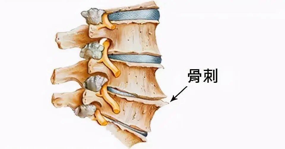 腰椎退行性变是怎么回事 腰椎退变的治疗方法