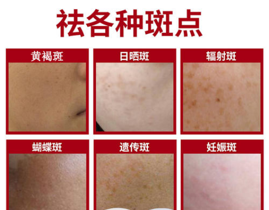脸上的斑种类有哪些直接对照就能看出自己属于哪种