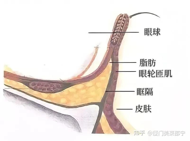 其实,眼袋是由眶隔筋膜内,中,外三团脂肪颗粒膨大形成的,有效去眼袋的