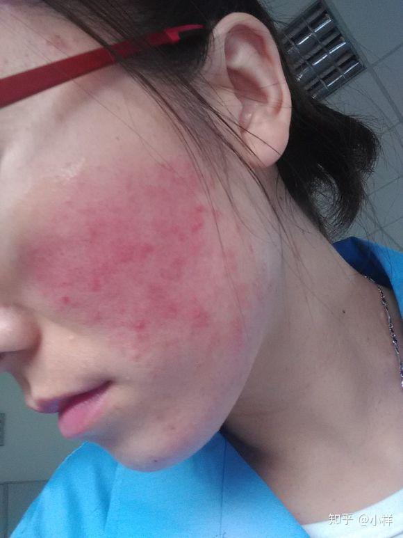 脸颊红血丝,又肿又干,满脸痘痘疹子,激素脸怎么修复 - 知乎