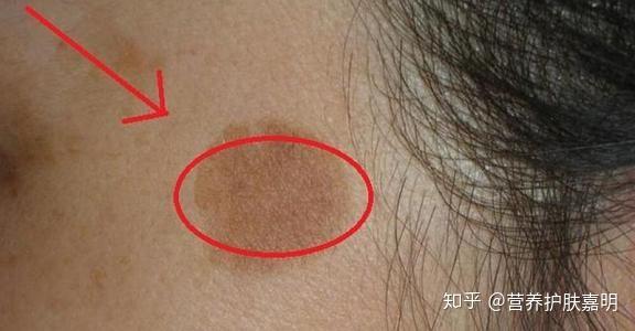 色素不均 斑点横生 究竟是哪步没做好 知乎