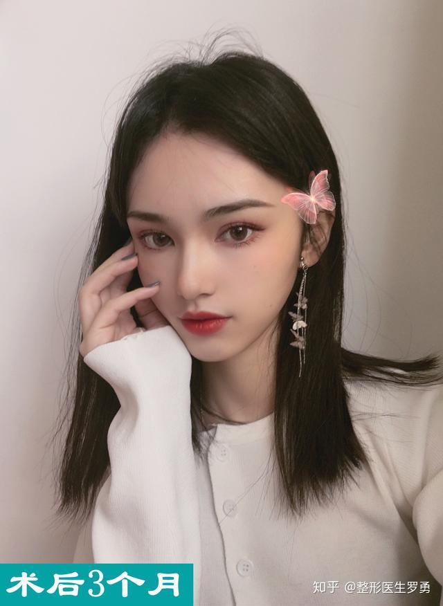 鼻修复|网红鼻是如何变成妈生鼻的?