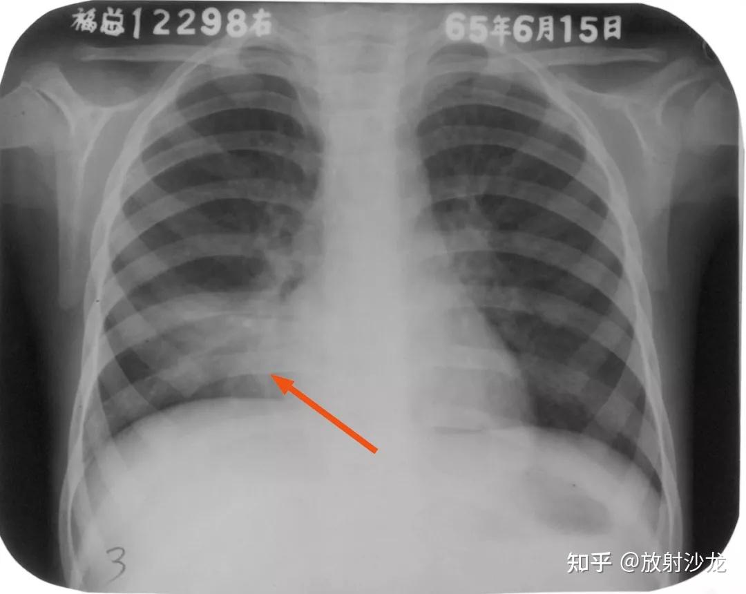 胸膜炎胸片图片