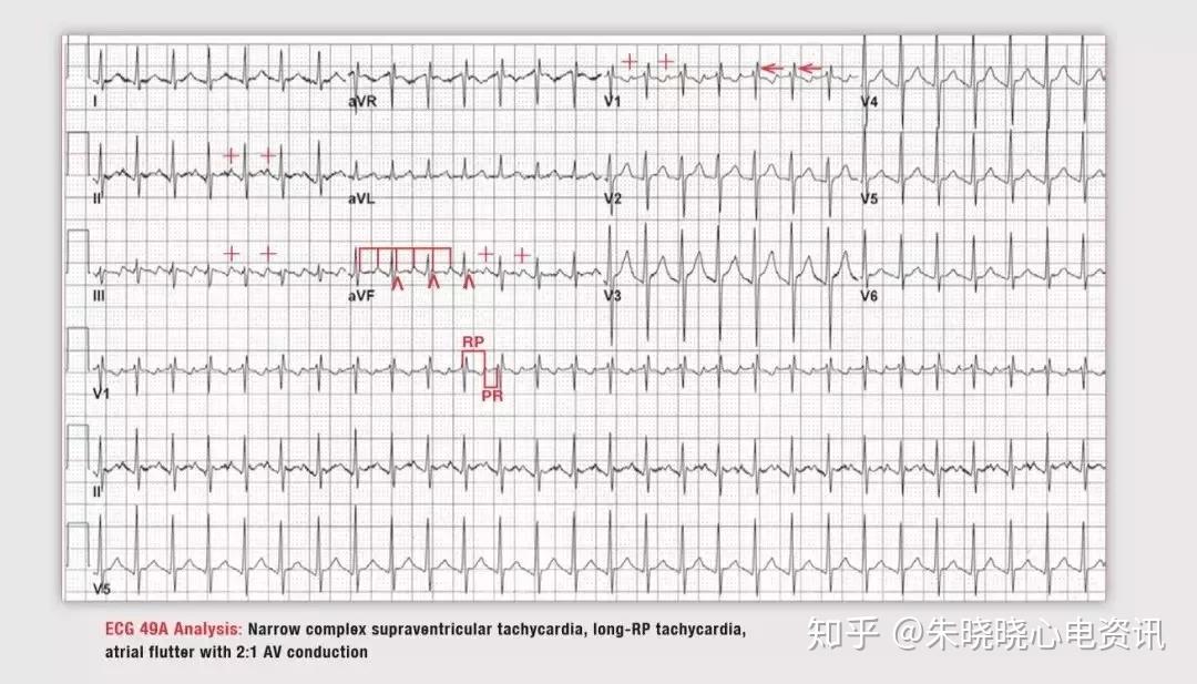 房速和房扑不好区分?记住这一点就行了