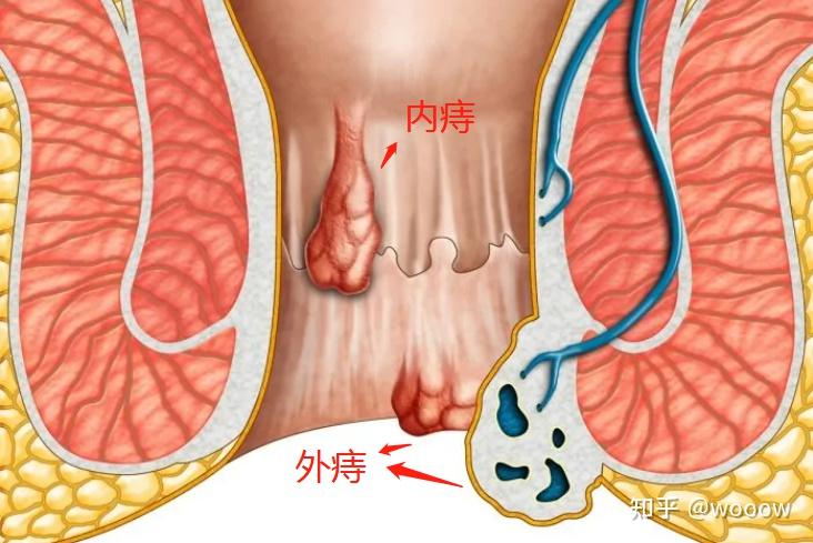 【对症下药】痔疮 