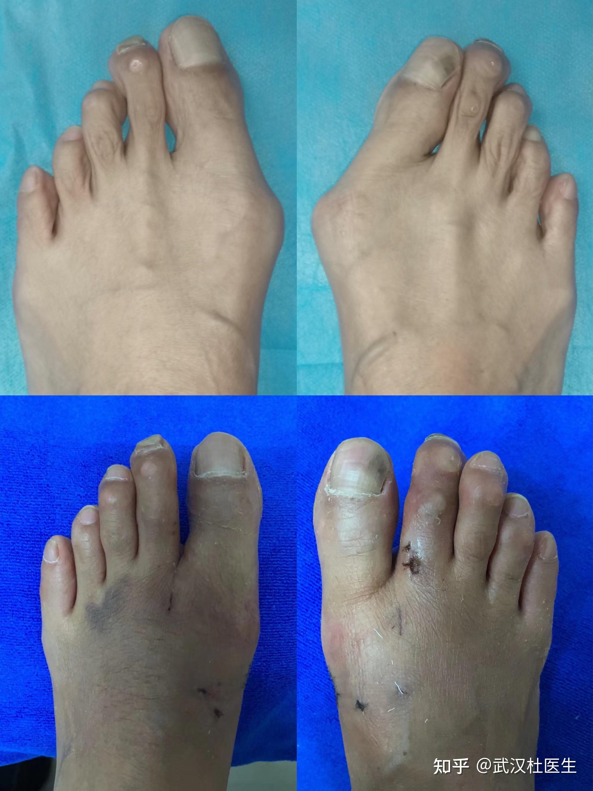 拇外翻案例分享