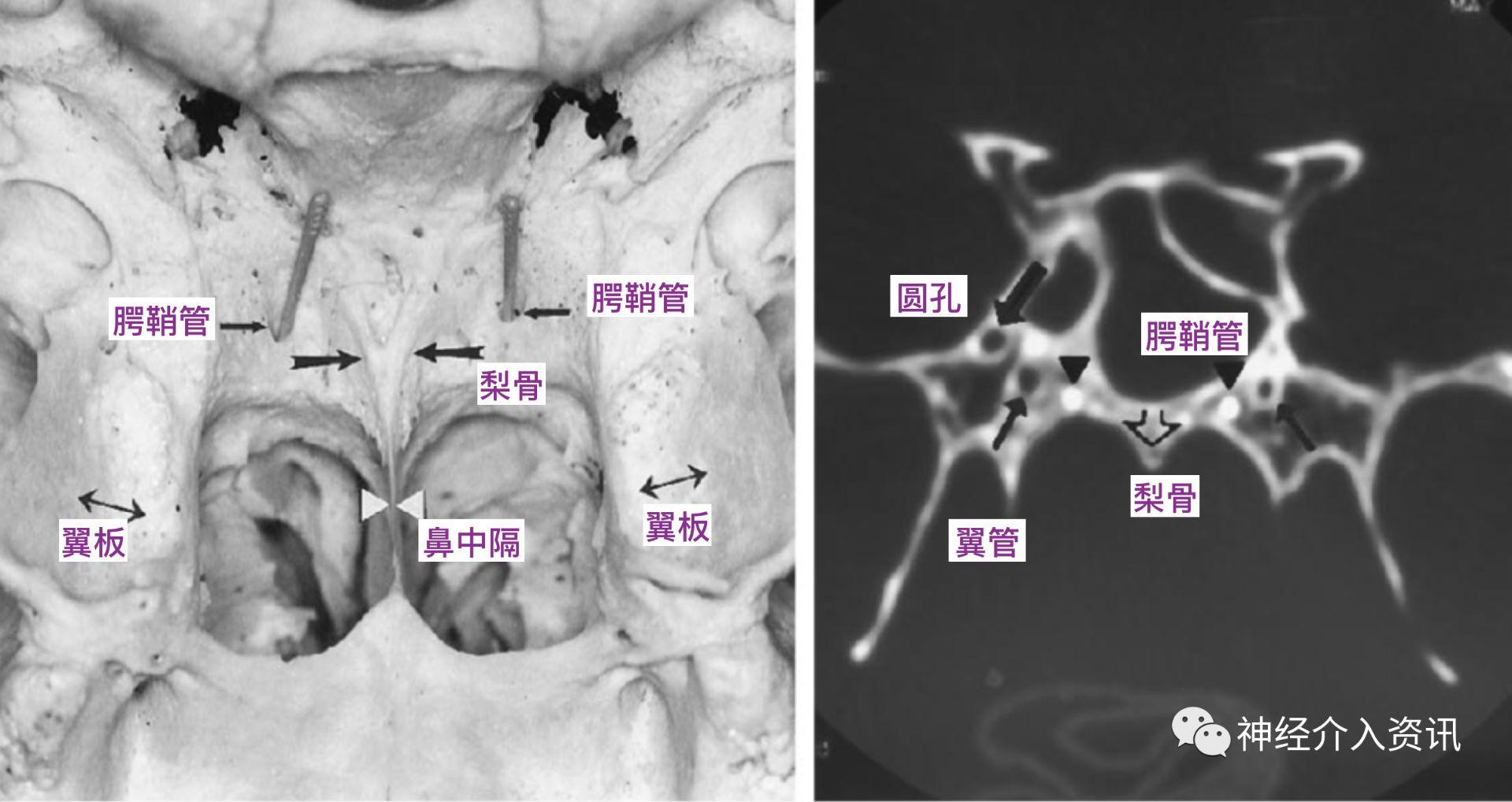 可见梨骨(大箭,翼板之间的翼窝(双箭头)和鼻中隔(箭头.