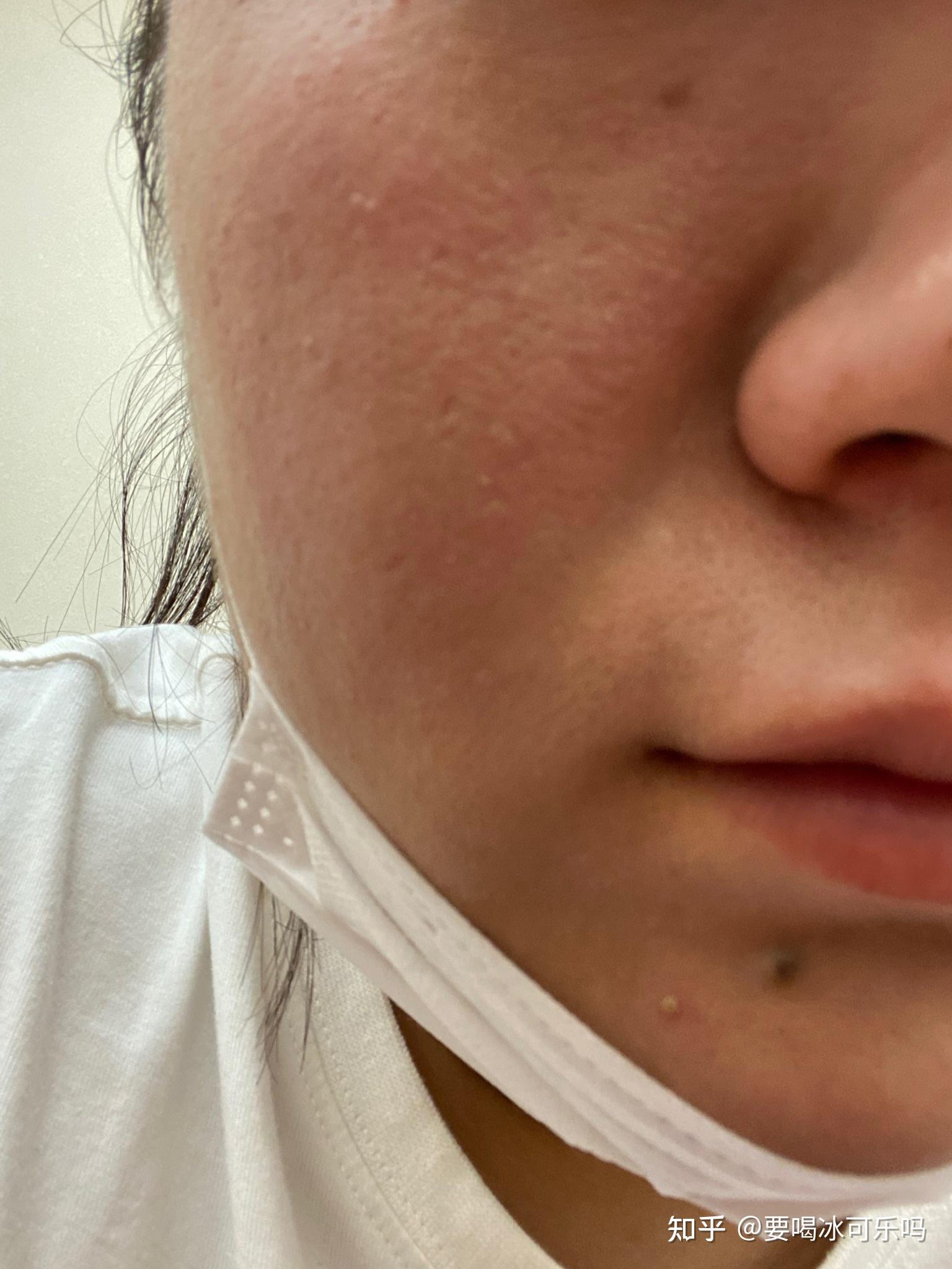 请帮忙看看我的是毛孔粗大还是冰锥型痘坑谢谢