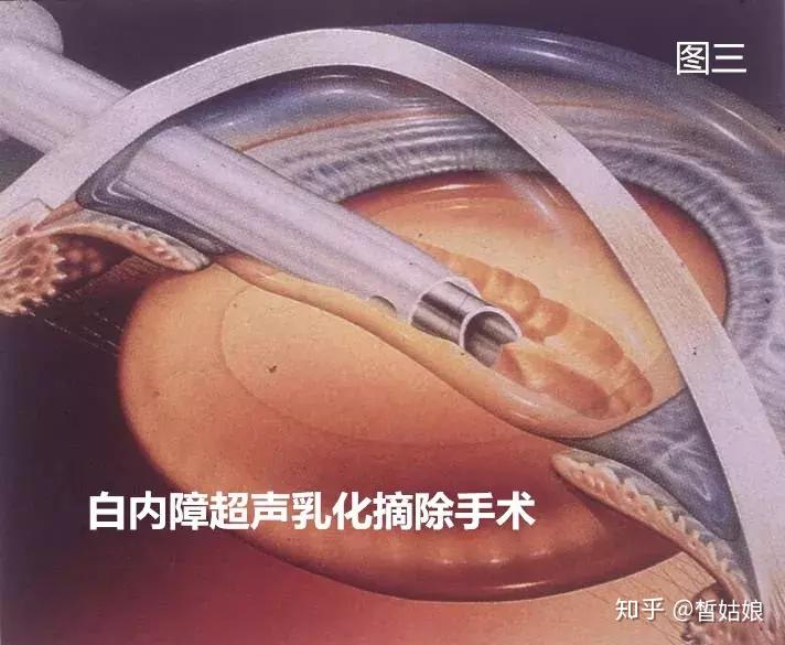 黄斑前膜和板层黄斑裂孔属于眼底疾病,带来的眼功能损伤都是不可逆的.