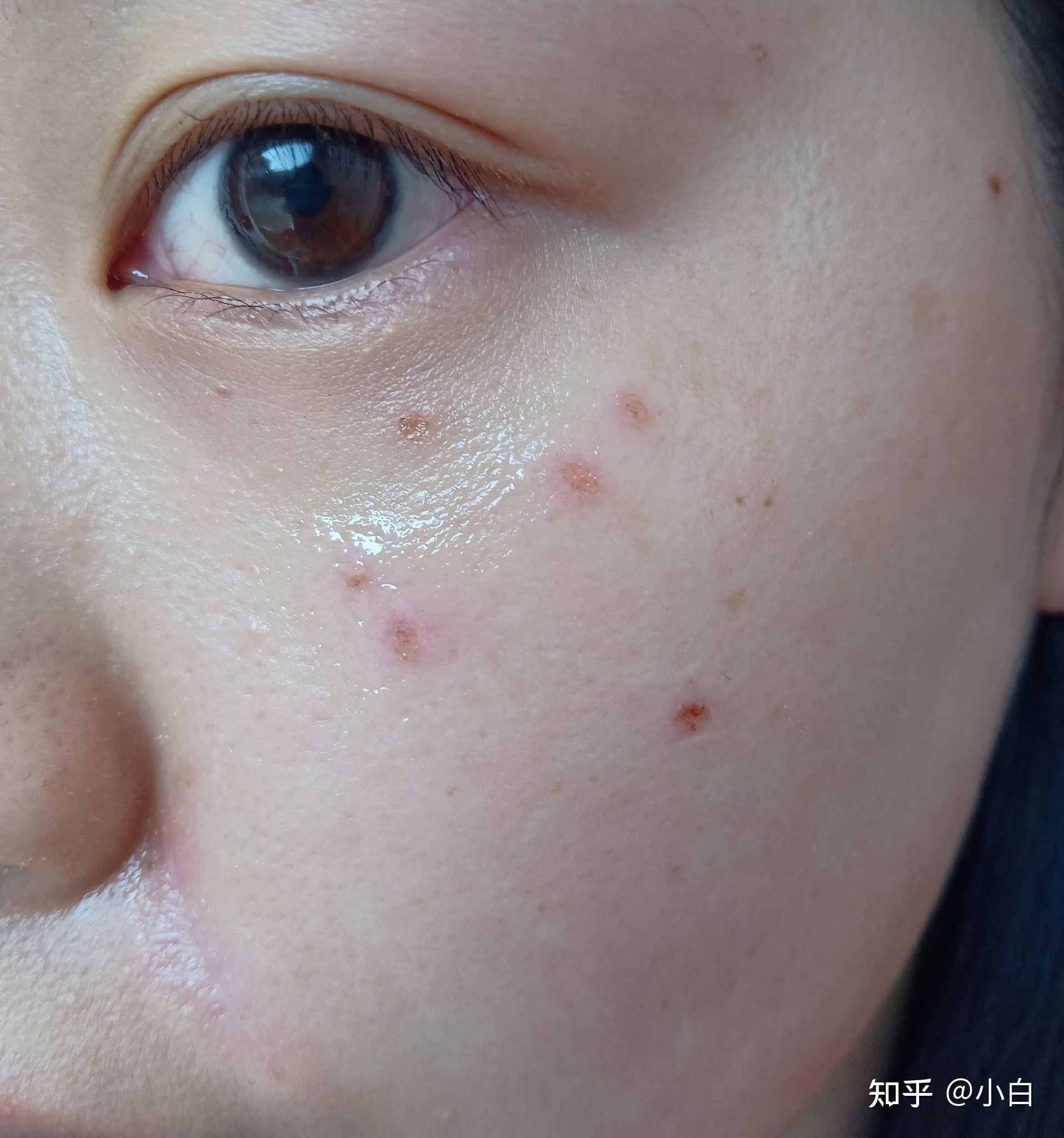 激光点痣记录 - 知乎