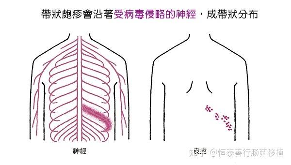 关于疱疹这件事你知多少？ - 知乎